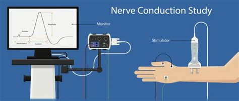 ncv test pasadena  This test is used to detect signs of nerve injury